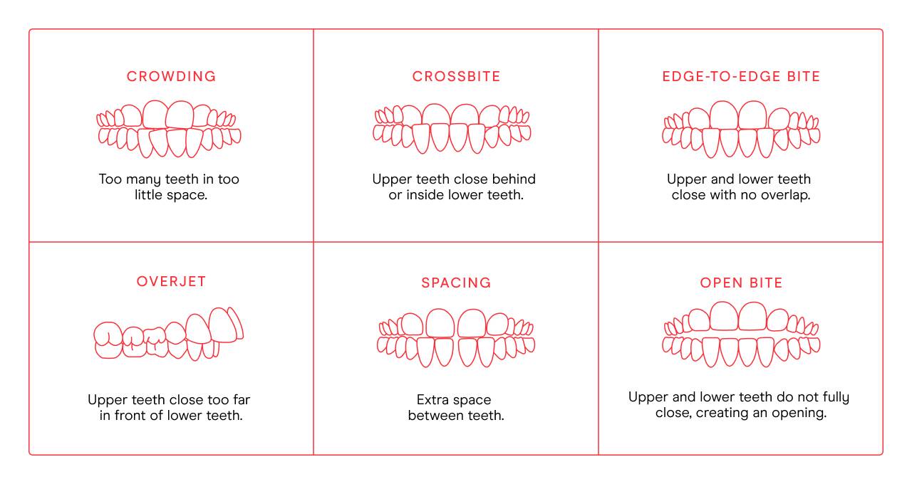 Malocclusion Chart